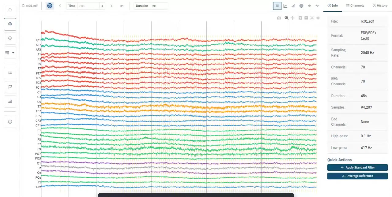 EEG Workbench showing thirty two channels of a clinical EDF recording on a shared time base